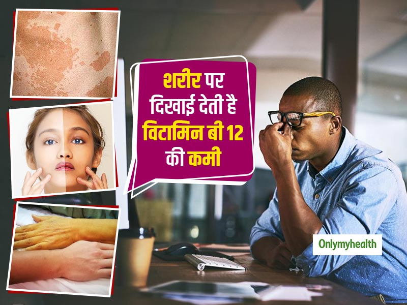 चेहरे पर आए ये 3 बड़े बदलाव हैं विटामिन बी 12 की कमी के संकेत, जानें कैसे पूरें इसकी कमी  